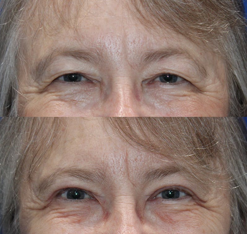 Upper Blepharoplasty Before & After Gallery - Patient 193921702 - Image 2