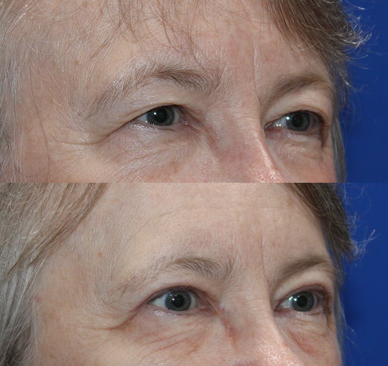 Upper Blepharoplasty Before & After Gallery - Patient 193921702 - Image 3
