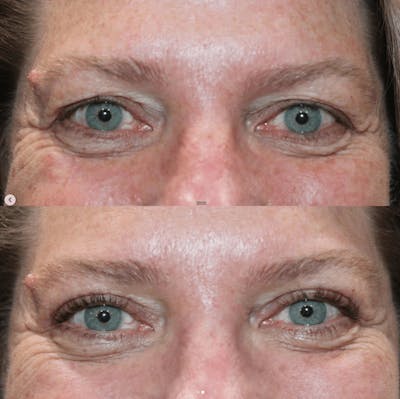 Upper Blepharoplasty Before & After Gallery - Patient 205287 - Image 1