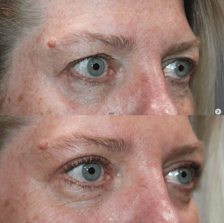 Upper Blepharoplasty Before & After Gallery - Patient 205287 - Image 2