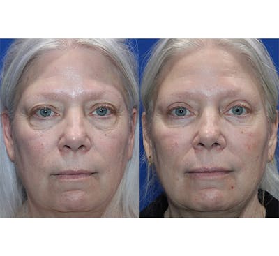 Lower Blepharoplasty Before & After Gallery - Patient 171337000 - Image 1