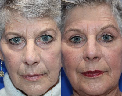 Upper Blepharoplasty Before & After Gallery - Patient 281651 - Image 1
