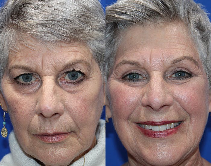 Upper Blepharoplasty Before & After Gallery - Patient 281651 - Image 3
