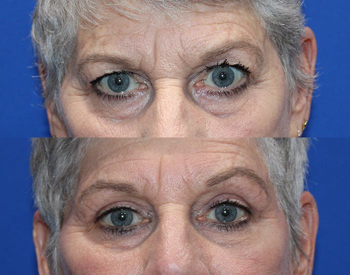 Upper Blepharoplasty Before & After Gallery - Patient 281651 - Image 2