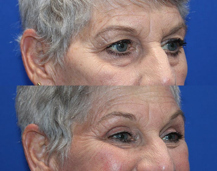 Upper Blepharoplasty Before & After Gallery - Patient 281651 - Image 12