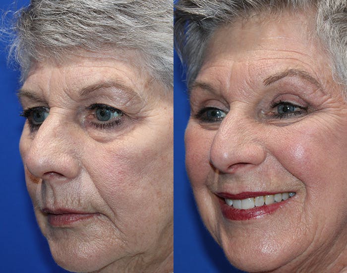 Upper Blepharoplasty Before & After Gallery - Patient 281651 - Image 6