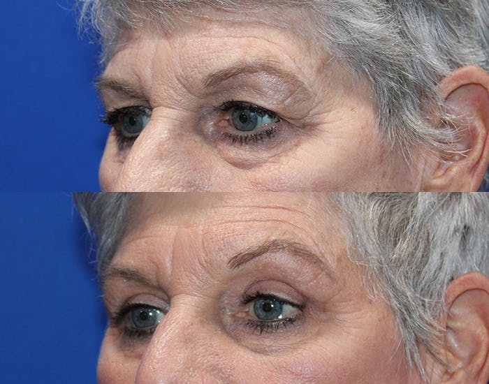 Upper Blepharoplasty Before & After Gallery - Patient 281651 - Image 7