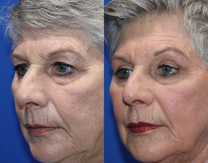 Upper Blepharoplasty Before & After Gallery - Patient 281651 - Image 5
