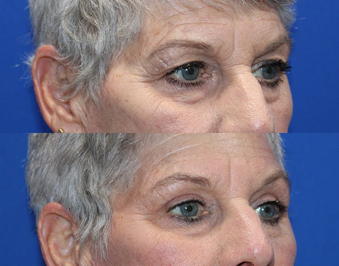 Upper Blepharoplasty Before & After Gallery - Patient 281651 - Image 11