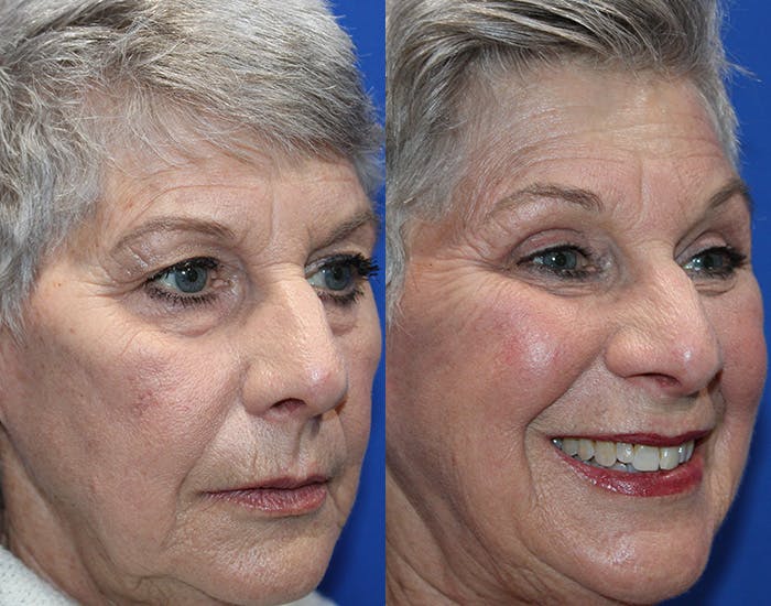 Upper Blepharoplasty Before & After Gallery - Patient 281651 - Image 10