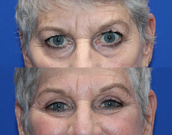 Upper Blepharoplasty Before & After Gallery - Patient 281651 - Image 4