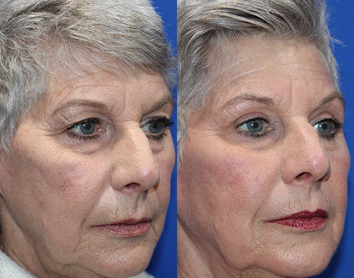 Upper Blepharoplasty Before & After Gallery - Patient 281651 - Image 9