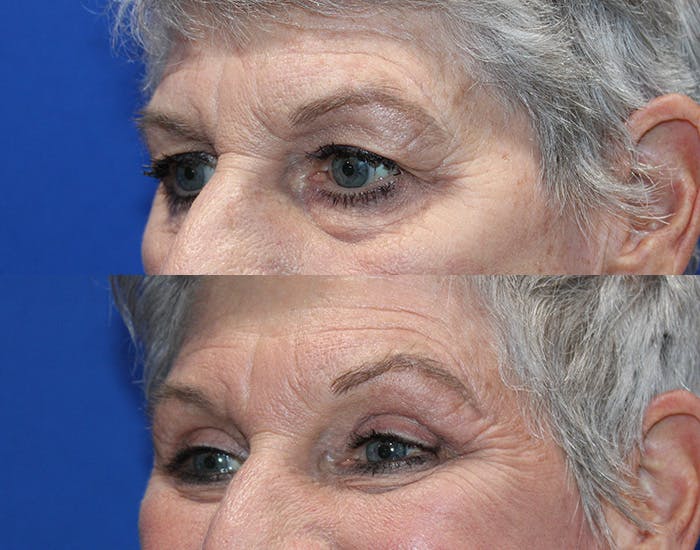 Upper Blepharoplasty Before & After Gallery - Patient 281651 - Image 8