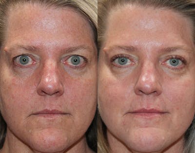 Upper Blepharoplasty Before & After Gallery - Patient 339178 - Image 1