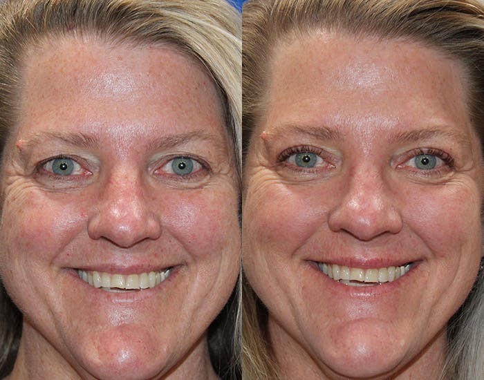 Upper Blepharoplasty Before & After Gallery - Patient 339178 - Image 3