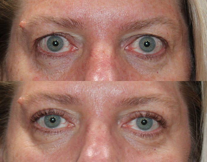 Upper Blepharoplasty Before & After Gallery - Patient 339178 - Image 2
