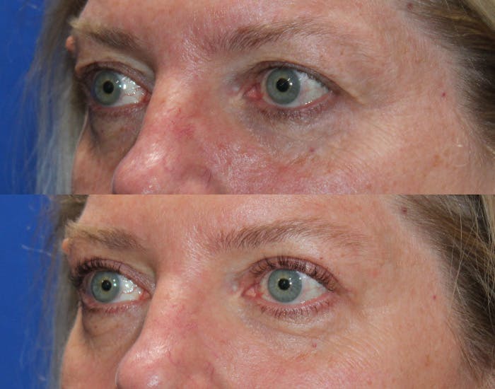 Upper Blepharoplasty Before & After Gallery - Patient 339178 - Image 6