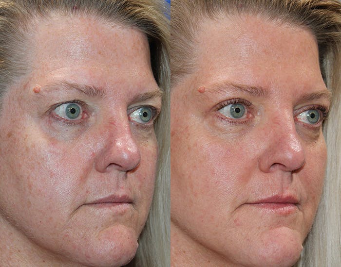 Upper Blepharoplasty Before & After Gallery - Patient 339178 - Image 7