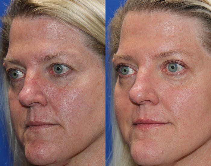 Upper Blepharoplasty Before & After Gallery - Patient 339178 - Image 5