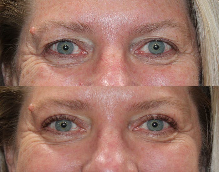 Upper Blepharoplasty Before & After Gallery - Patient 339178 - Image 4