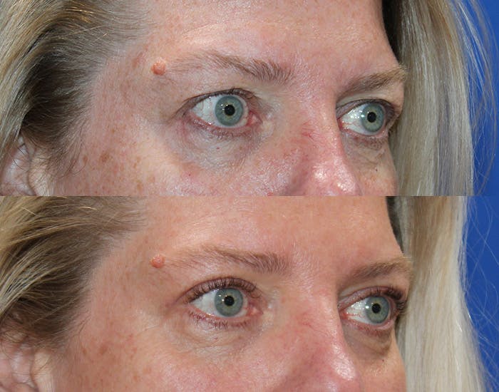 Upper Blepharoplasty Before & After Gallery - Patient 339178 - Image 8