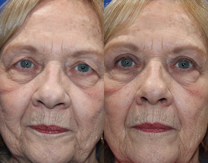 Upper Blepharoplasty Before & After Gallery - Patient 265820 - Image 1
