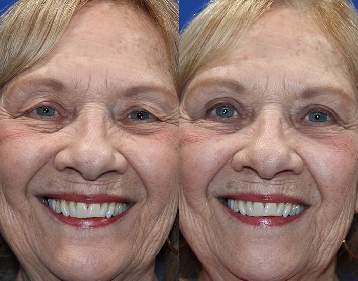 Upper Blepharoplasty Before & After Gallery - Patient 265820 - Image 3