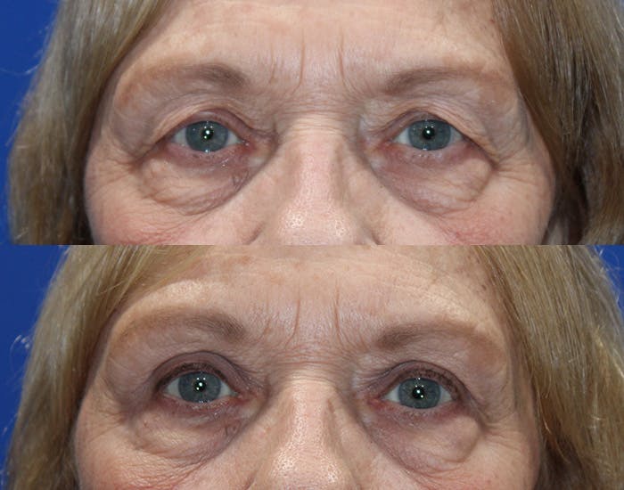 Upper Blepharoplasty Before & After Gallery - Patient 265820 - Image 2