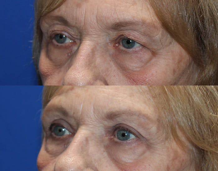 Upper Blepharoplasty Before & After Gallery - Patient 265820 - Image 6