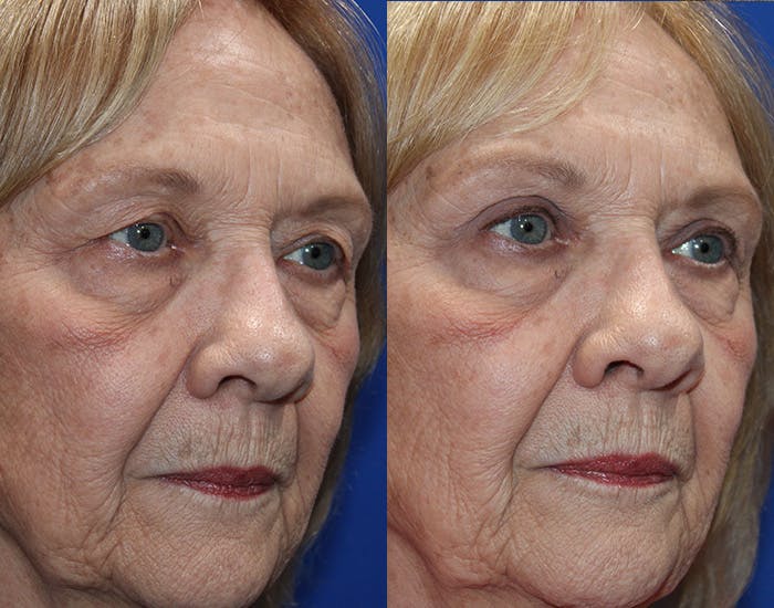 Upper Blepharoplasty Before & After Gallery - Patient 265820 - Image 7