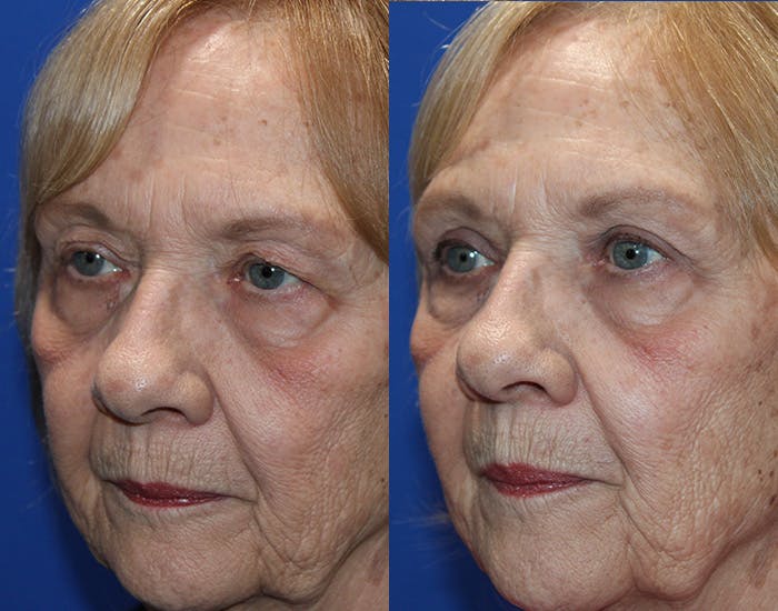 Upper Blepharoplasty Before & After Gallery - Patient 265820 - Image 5