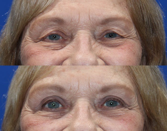Upper Blepharoplasty Before & After Gallery - Patient 265820 - Image 4
