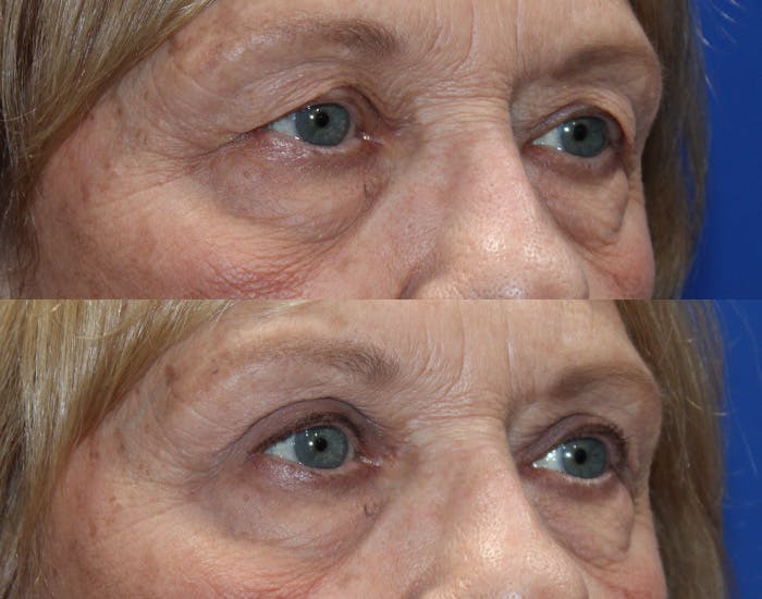 Upper Blepharoplasty Before & After Gallery - Patient 265820 - Image 8
