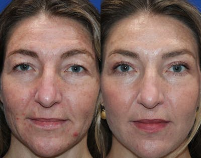 Upper Blepharoplasty Before & After Gallery - Patient 862756 - Image 1