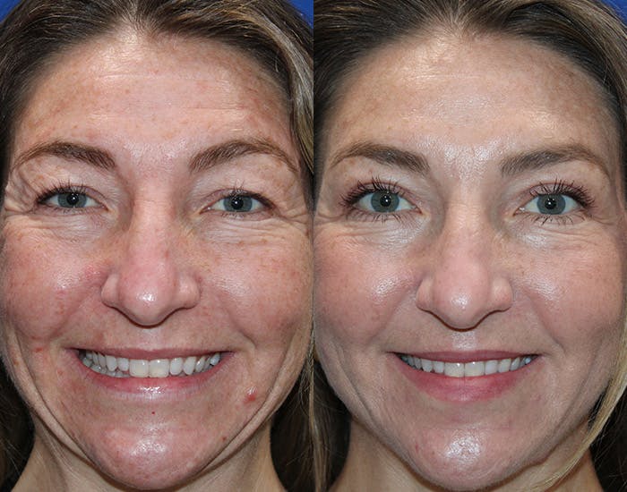 Upper Blepharoplasty Before & After Gallery - Patient 862756 - Image 3