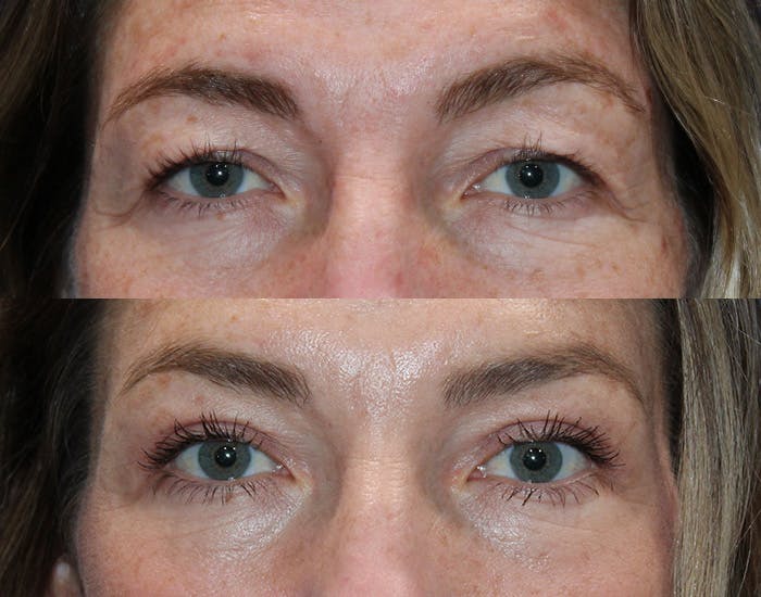 Upper Blepharoplasty Before & After Gallery - Patient 862756 - Image 2