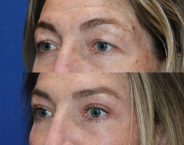 Upper Blepharoplasty Before & After Gallery - Patient 862756 - Image 6