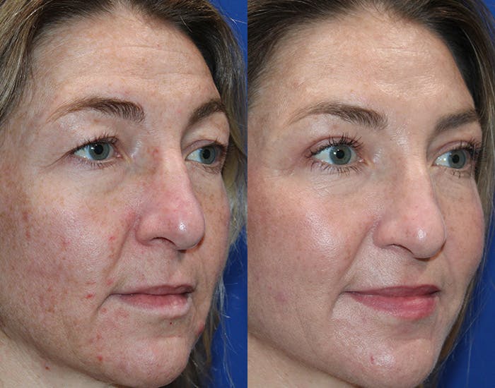 Upper Blepharoplasty Before & After Gallery - Patient 862756 - Image 7