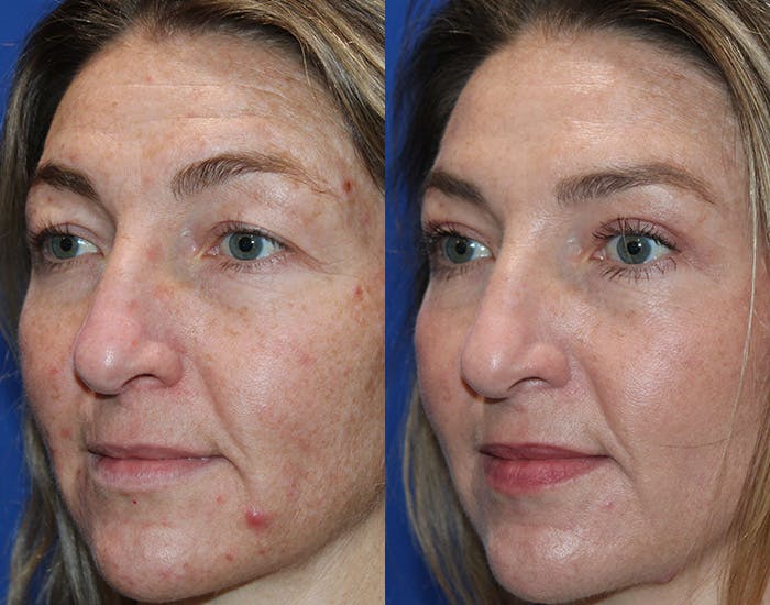 Upper Blepharoplasty Before & After Gallery - Patient 862756 - Image 5