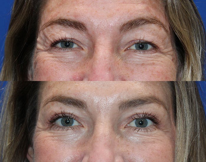 Upper Blepharoplasty Before & After Gallery - Patient 862756 - Image 4