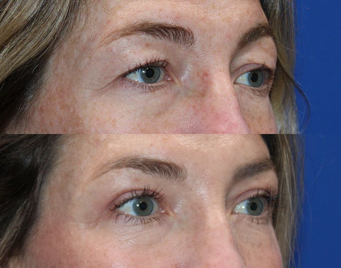 Upper Blepharoplasty Before & After Gallery - Patient 862756 - Image 8