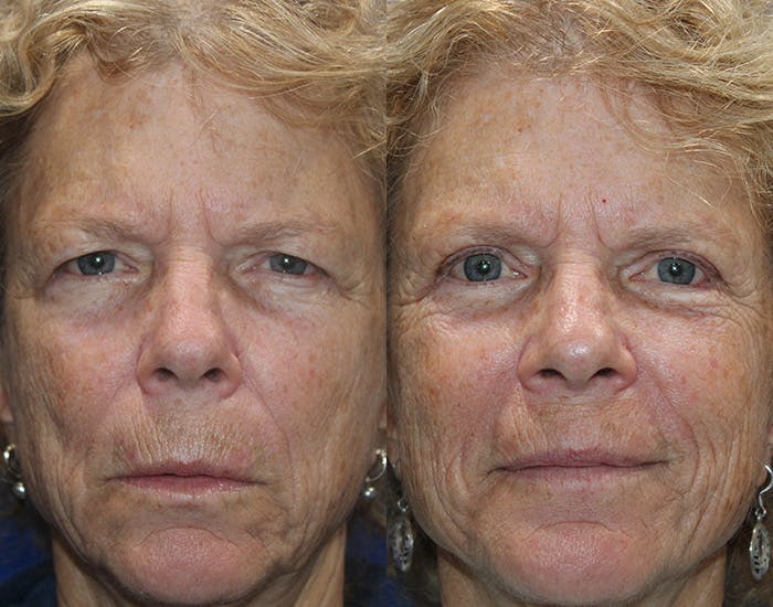 Upper Blepharoplasty Before & After Gallery - Patient 778399 - Image 1