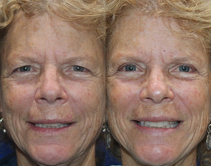 Upper Blepharoplasty Before & After Gallery - Patient 778399 - Image 3