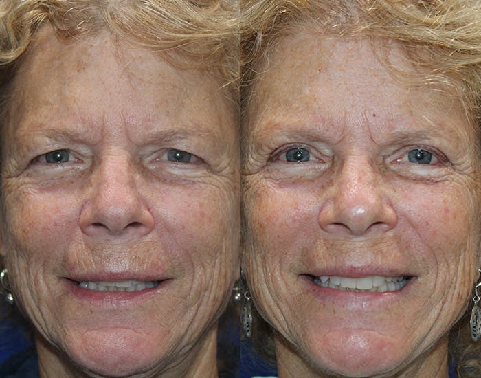 Upper Blepharoplasty Before & After Gallery - Patient 778399 - Image 3