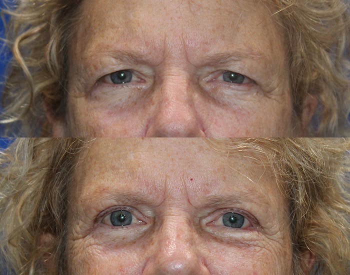 Upper Blepharoplasty Before & After Gallery - Patient 778399 - Image 2