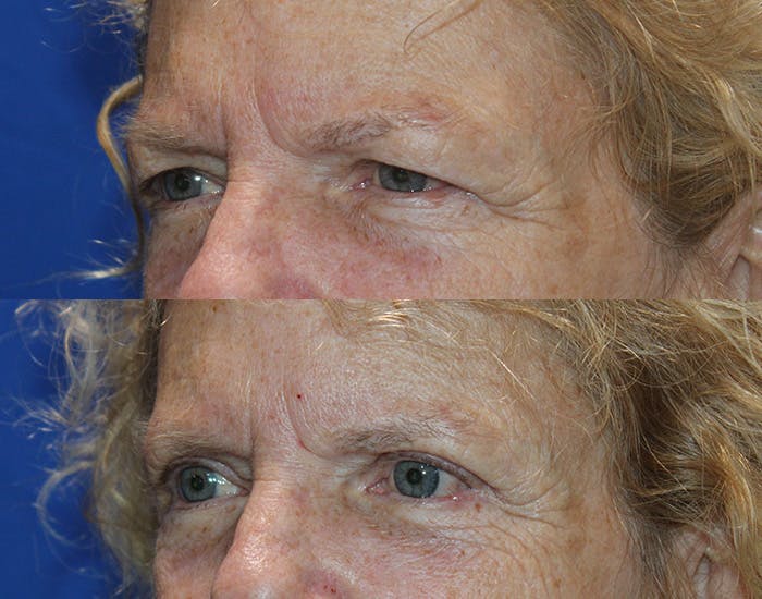 Upper Blepharoplasty Before & After Gallery - Patient 778399 - Image 6