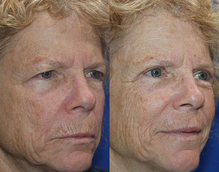 Upper Blepharoplasty Before & After Gallery - Patient 778399 - Image 7