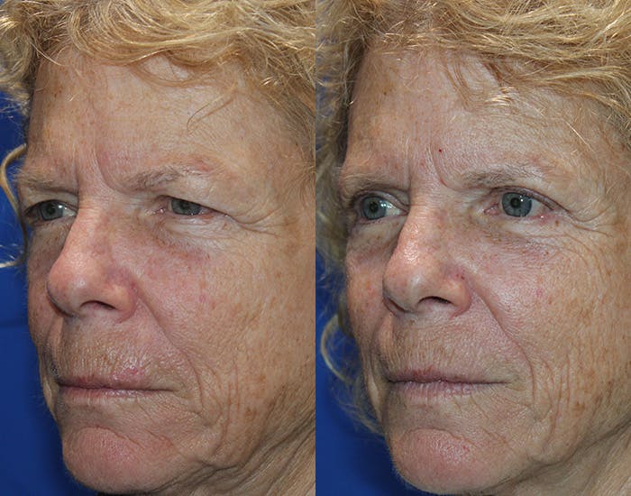 Upper Blepharoplasty Before & After Gallery - Patient 778399 - Image 5