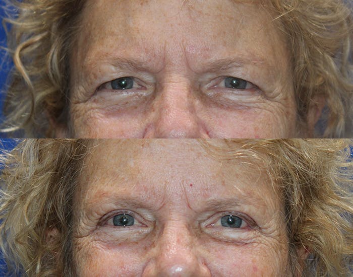 Upper Blepharoplasty Before & After Gallery - Patient 778399 - Image 4