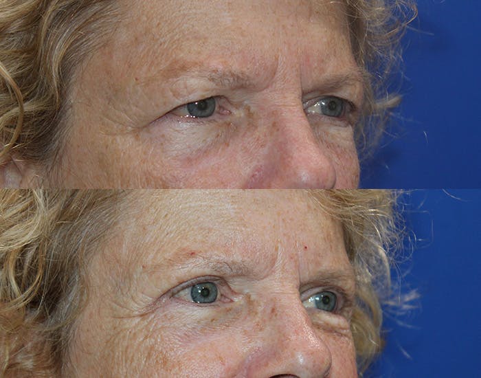 Upper Blepharoplasty Before & After Gallery - Patient 778399 - Image 8